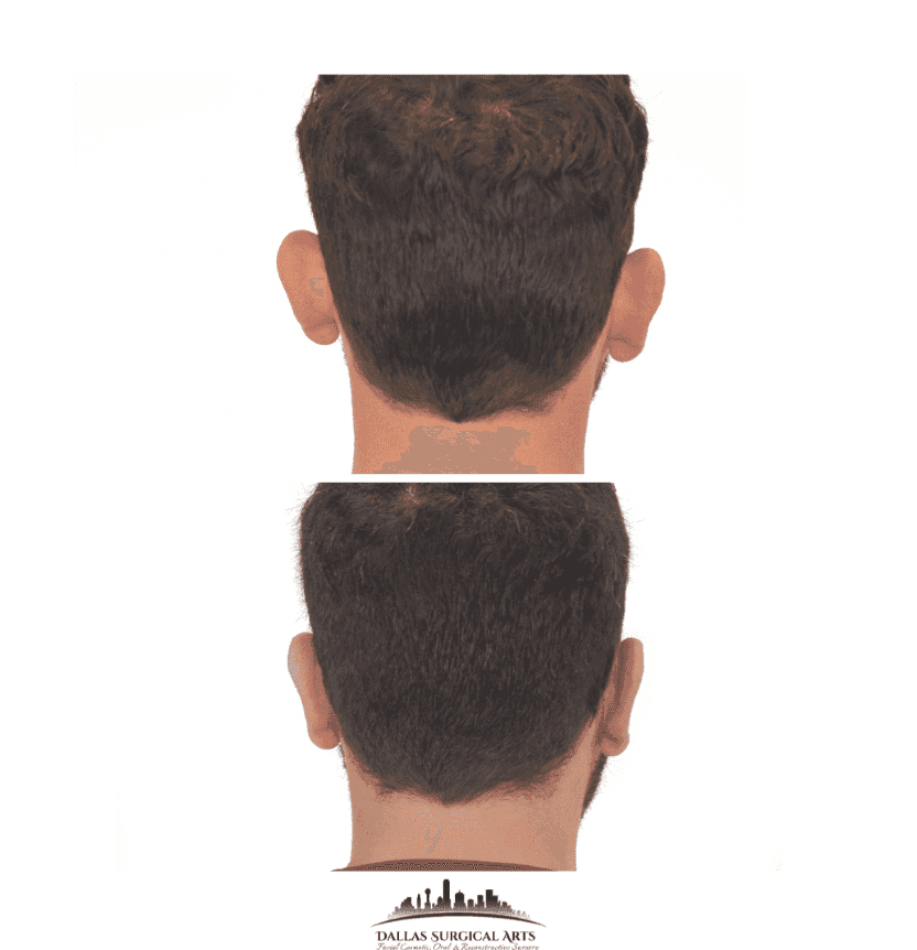Otoplasty at Dallas Surgical Arts: Dallas Ear Surgery