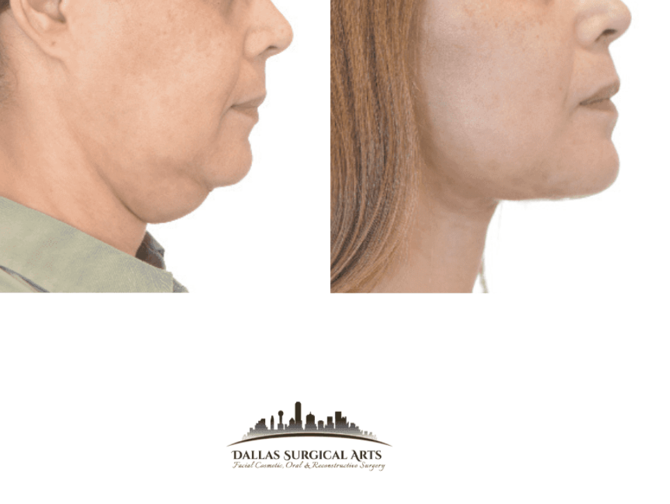 Dr. Randy Sanovich - Dallas Texas Turkey Neck: Causes, Prevention, and Treatments