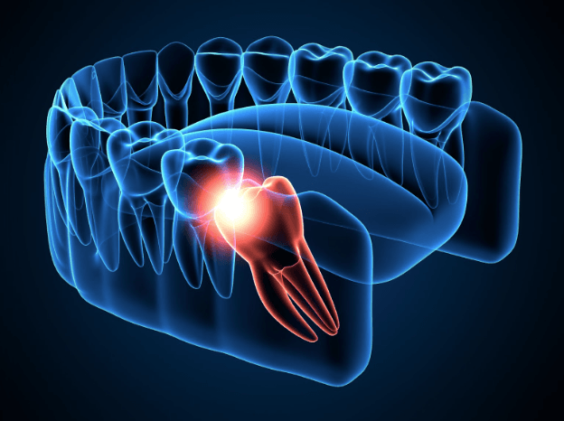 Wisdom Teeth: Debunking Myths and Understanding Their Impact on Facial Appearance- Dallas Oral Surgeon Dr. Randy Sanovich