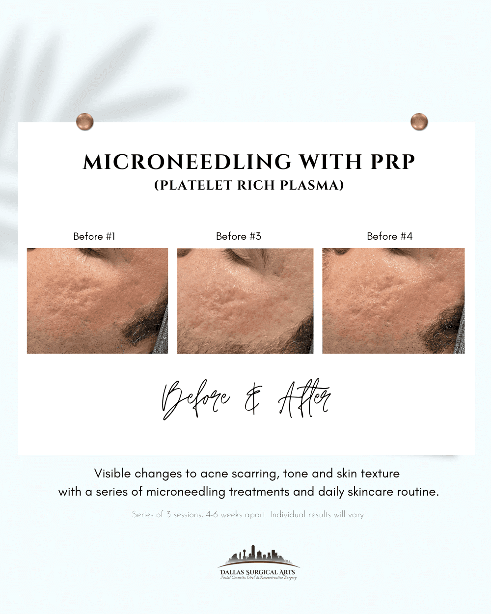 Microneedling At Dallas Surgical Arts