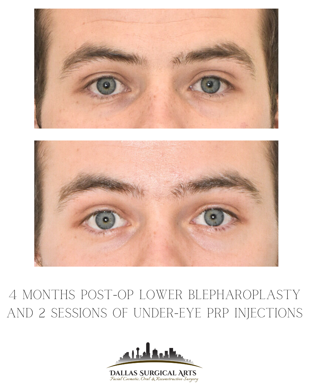 Reversing the Appearance of Aging with Eyelid Surgery (Blepharoplasty) - best blepharoplasty surgeon dallas