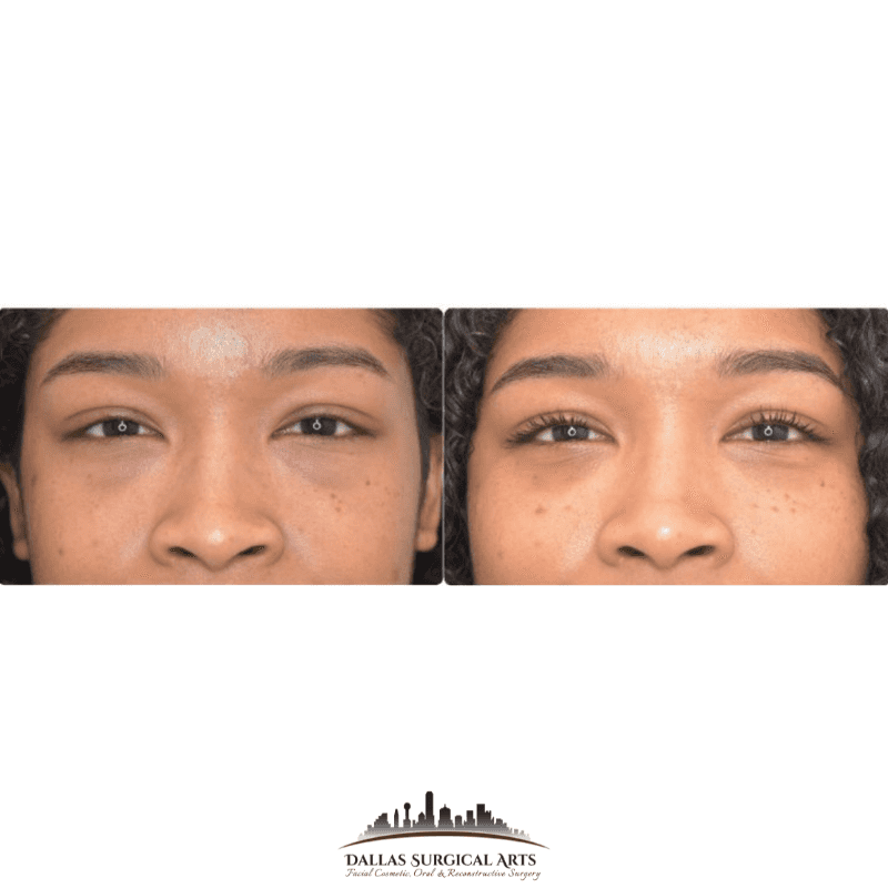 Blepharoplasty or Skin Pinch, What's the Difference?
