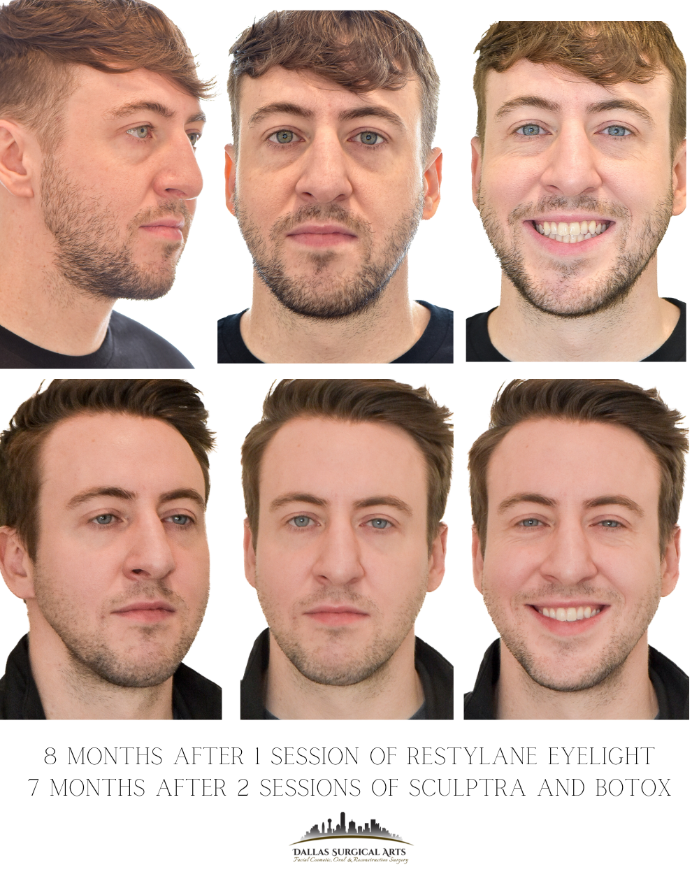 Botox vs. Dysport: Which Neurotoxin is Best for Your Wrinkles? The Dallas Guide to Preventative Botox and Dysport