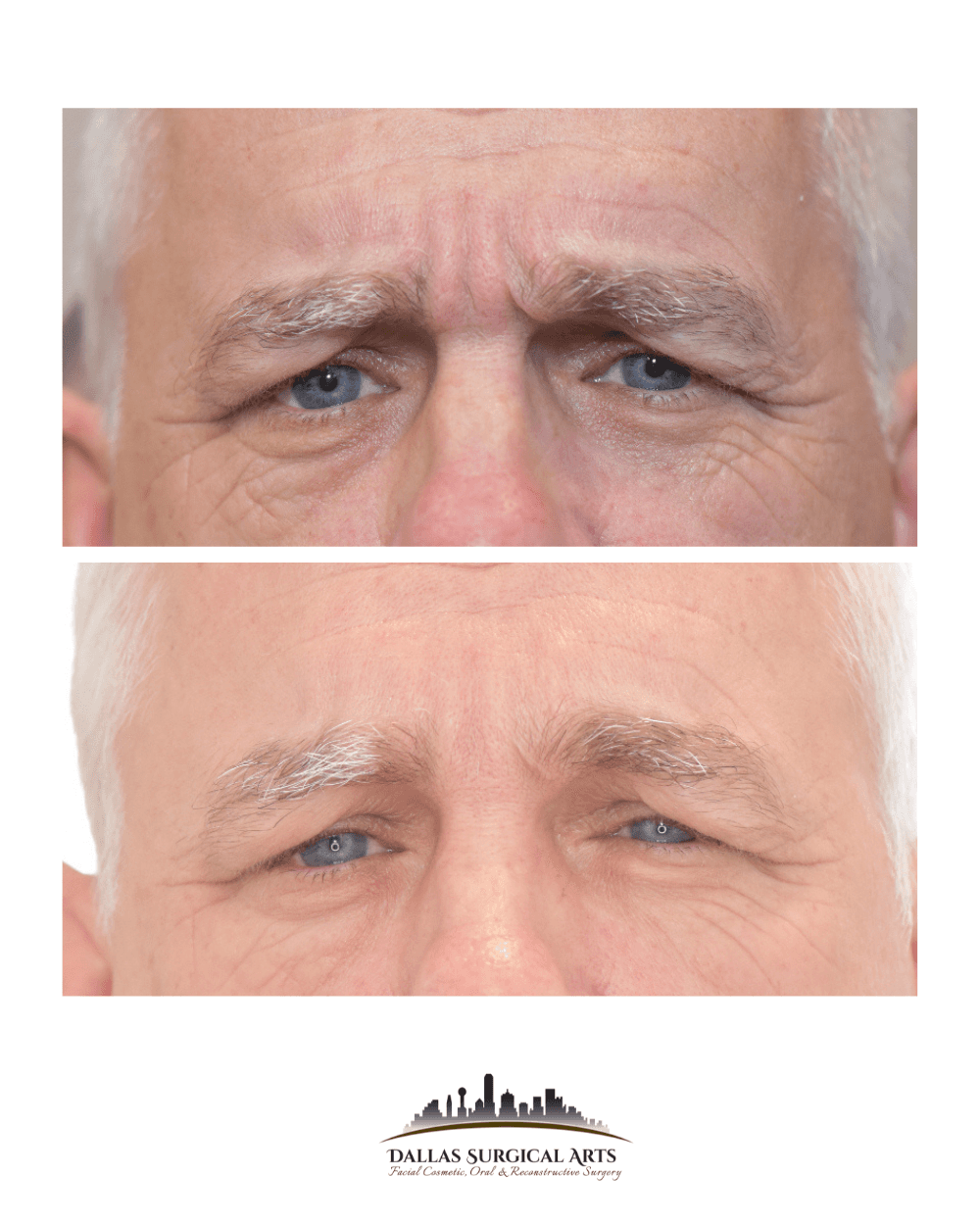 Botox | Dallas Oral Surgery