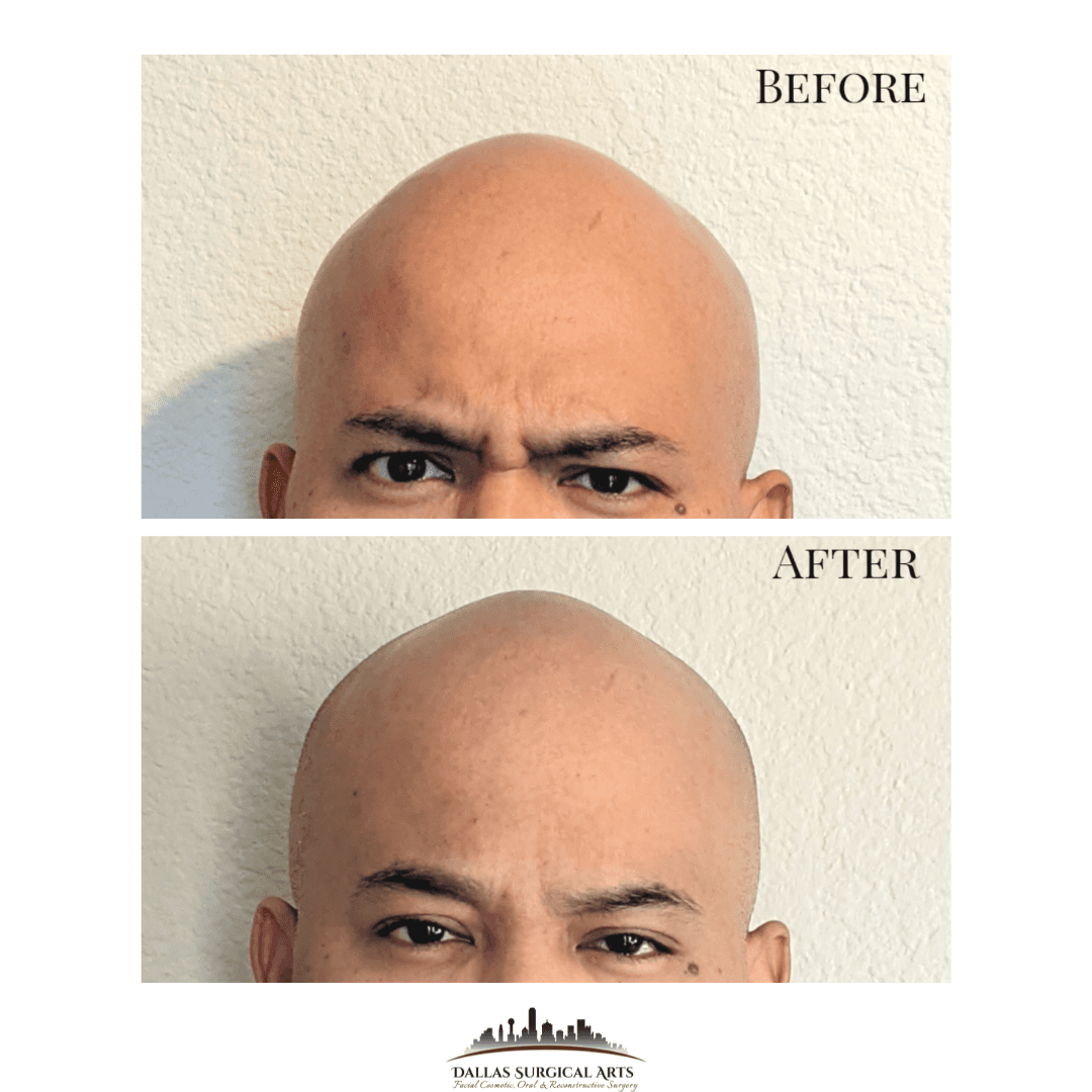 Botox | Dallas Oral Surgery