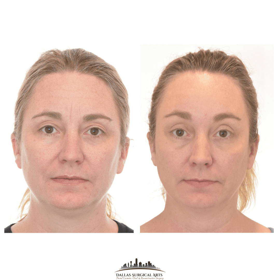 Brow Lift Oral Surgery in Dallas