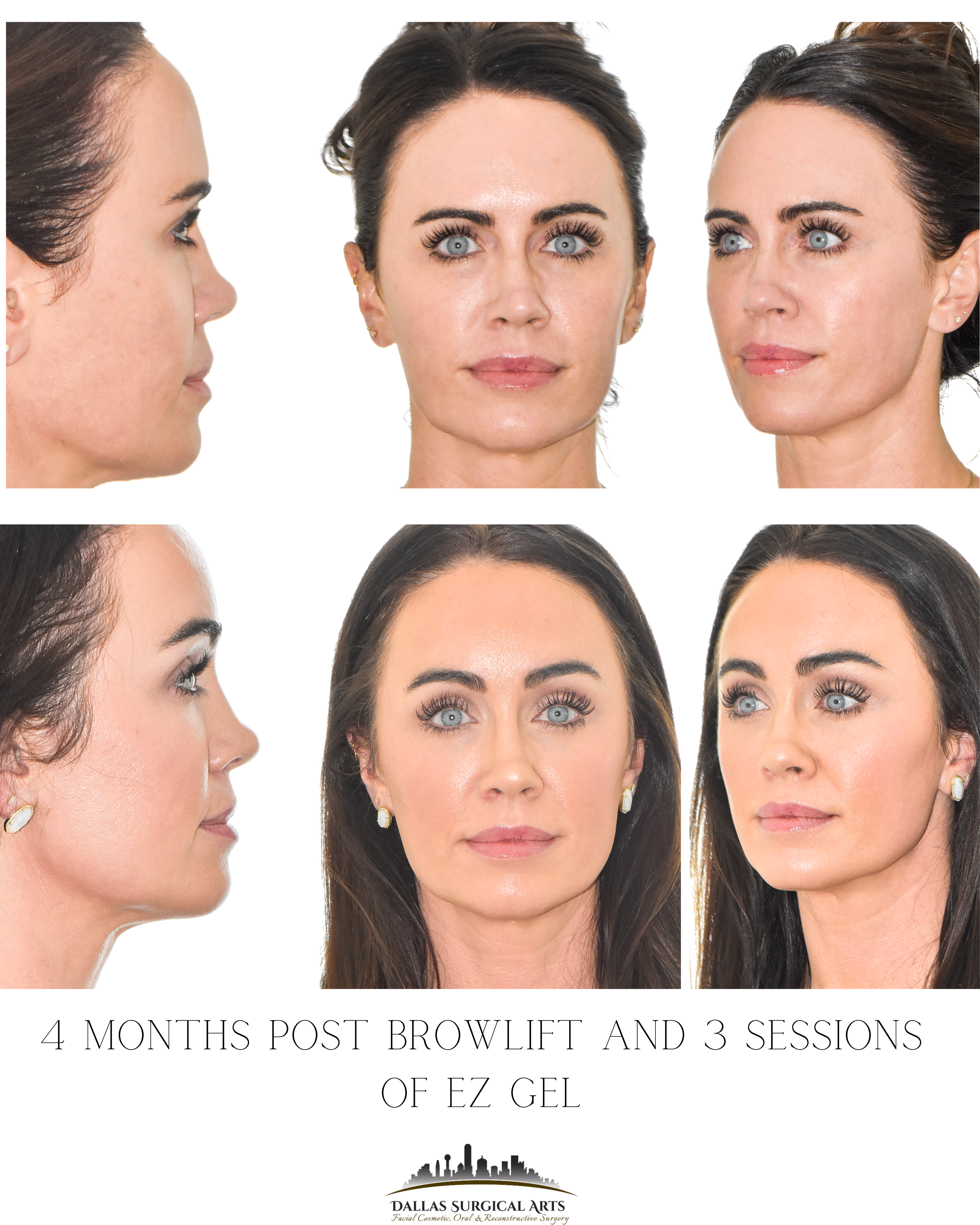 Brow Lift and Asymmetry - Addressing an Asymmetry with Endoscopic Brow Lift in Dallas