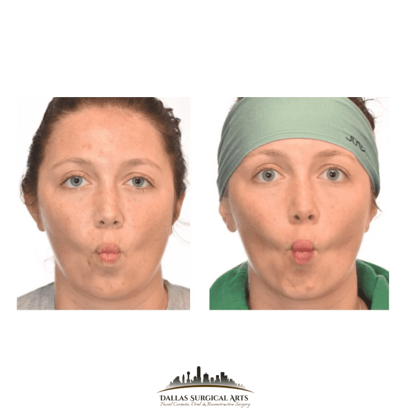 Dallas Cheek Liposuction (Buccal Fat Removal) - Why Patients Love This Slimming Procedure