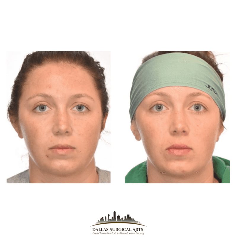 Buccal Fat Removal Dallas Oral Surgery