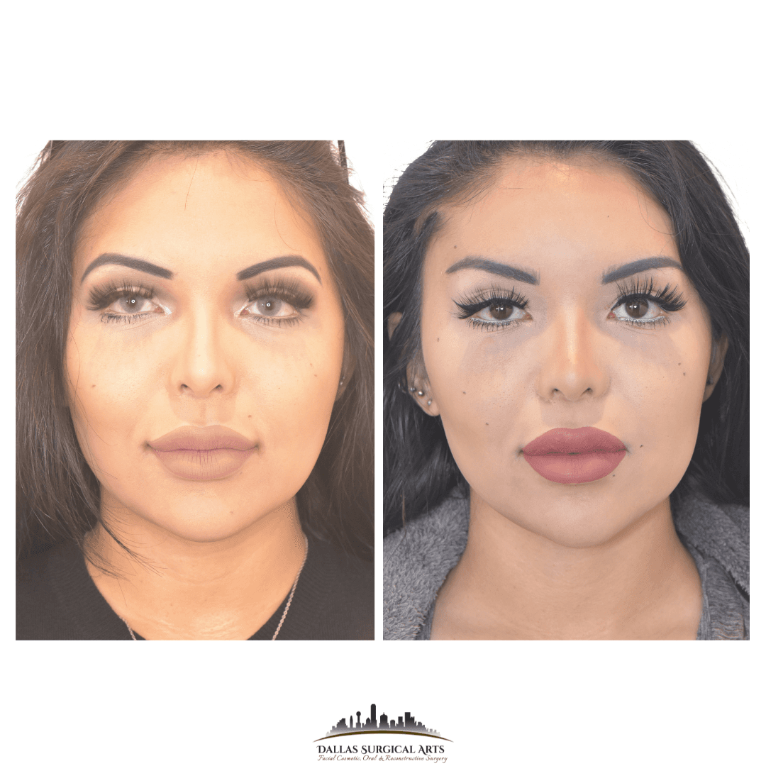 Buccal Fat Removal Oral Surgery in Dallas