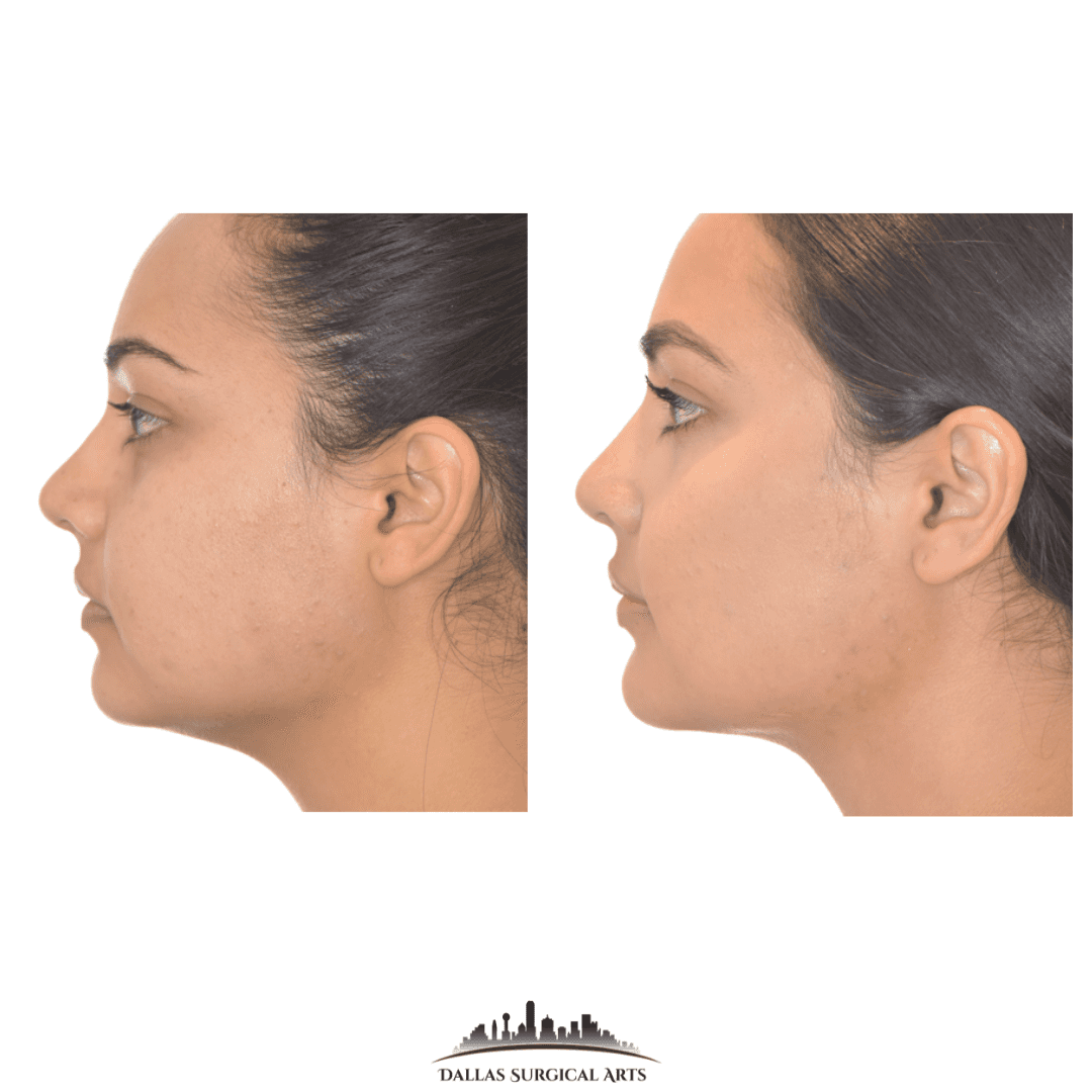 Buccal Fat Removal Dallas Oral Surgery