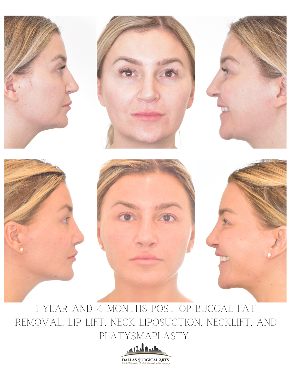 What to Know About Facial Fat Removal in Dallas (Buccal Fat - Bichectomy Procedure)