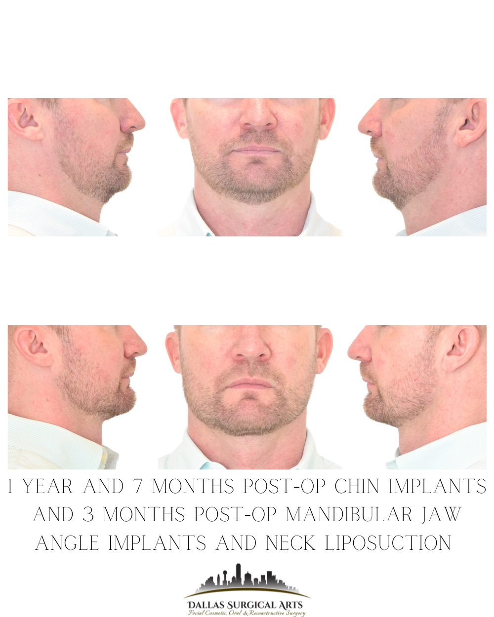 Chin and Jaw Implant Surgery - Is This Procedure Right for You?