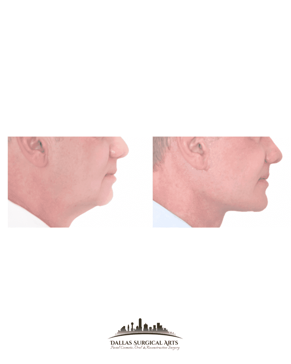 Chin Implants in Dallas and Their Impact on Jawlines