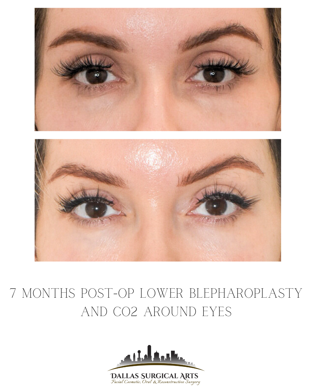 Laser Treatment for Under-Eye Bags Vs. Blepharoplasty