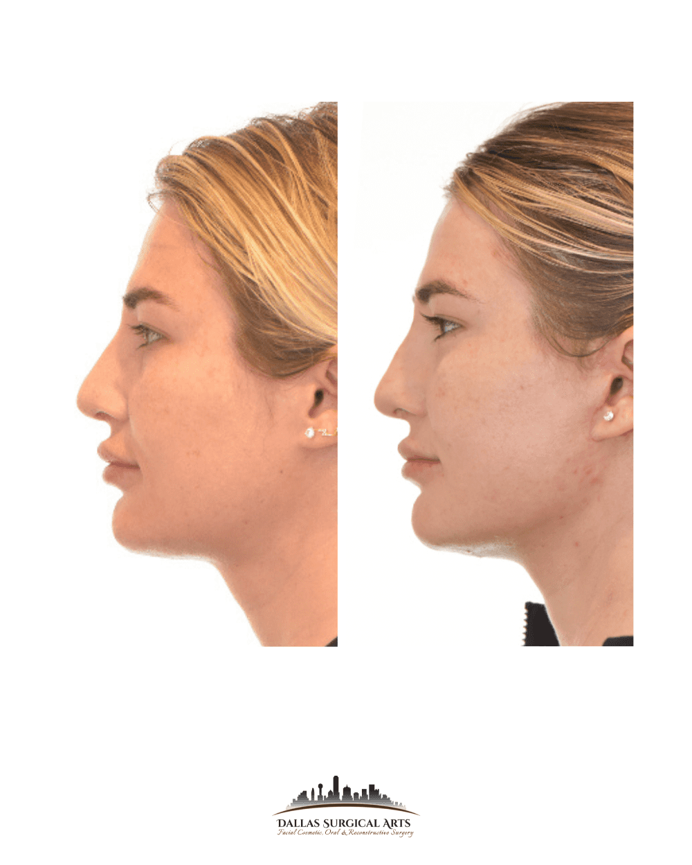 Embracing Subtle, Natural-Looking Results at Dallas Surgical Arts