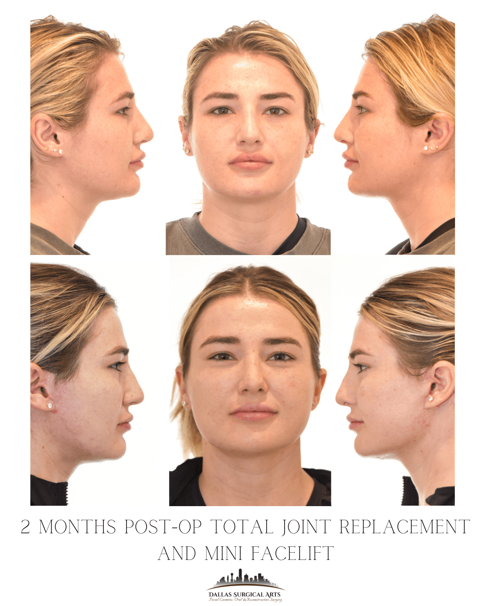 Mini Facelift Surgery Options in Dallas
