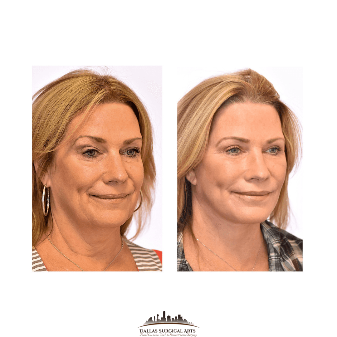 Facelift Oral Surgery in Dallas