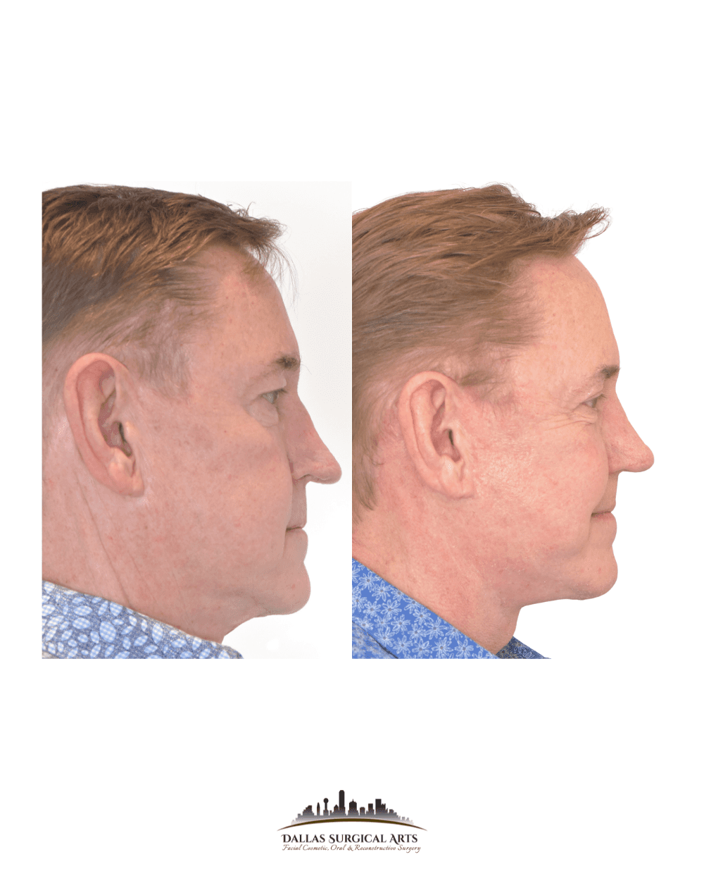 Cosmetic Surgery Trends in 2025 - Facial Fat Transfer in Dallas