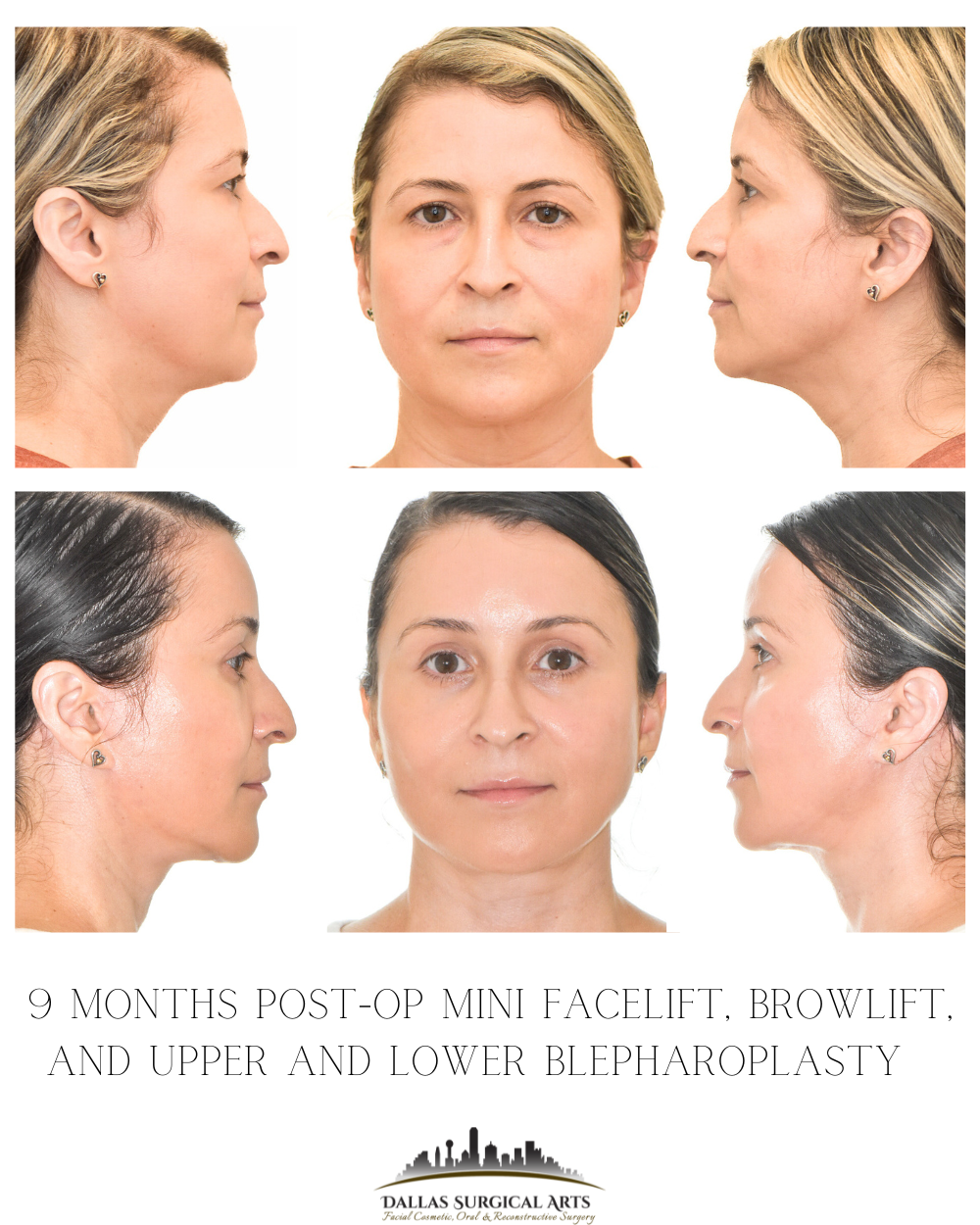 Why Choose a Mini Facelift? All About Mini Facelift in Dallas