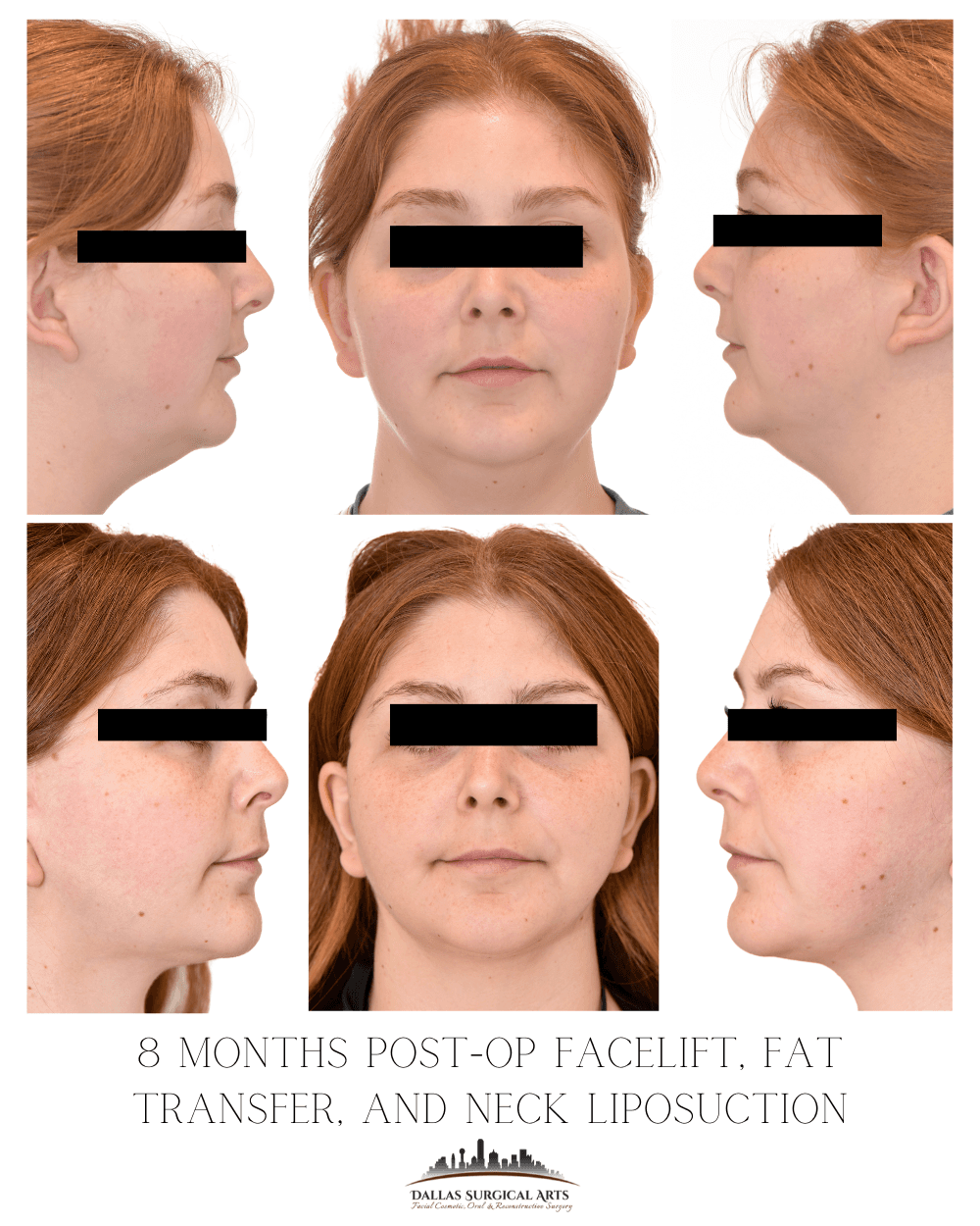 Why 30-Somethings Are Opting for Mini Neck Lifts in Dallas