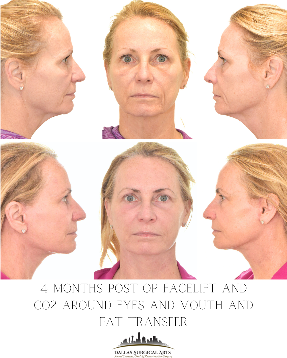 How to Choose the Best Facelift Surgeon in Dallas: Key Factors to Consider