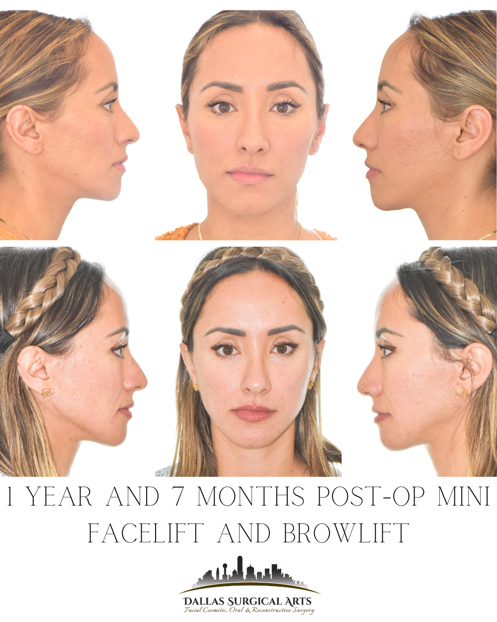 Ponytail Facelift - Insights from Top Dallas Facelift Surgeon Dr. Randy Sanovich