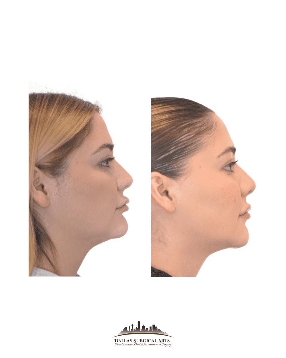Genioplasty and Chin Liposuction: Contouring for Every Face Shape