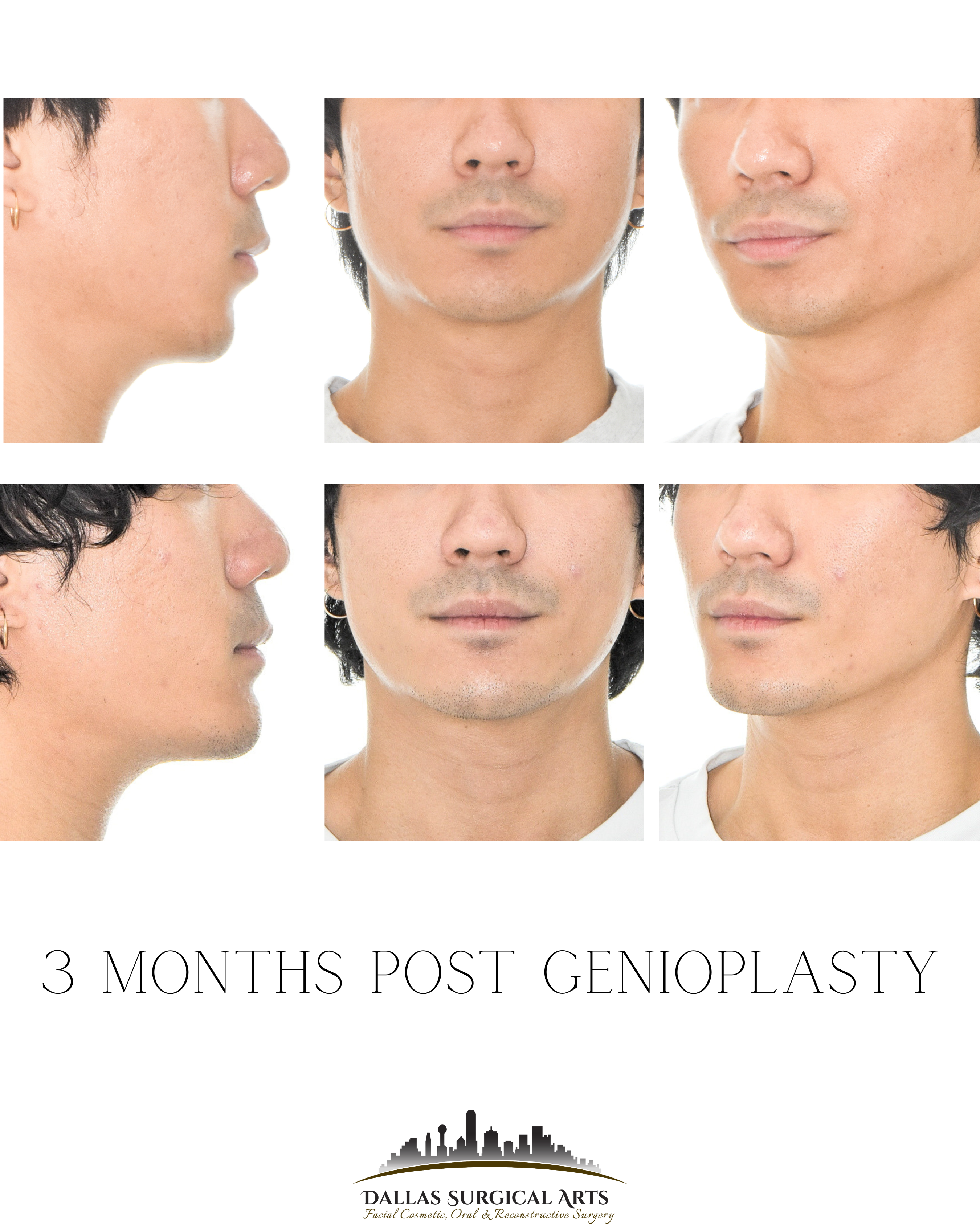 Refine Your Side Profile - Male and Female Facial Sculpting Treatments and Procedures in Dallas