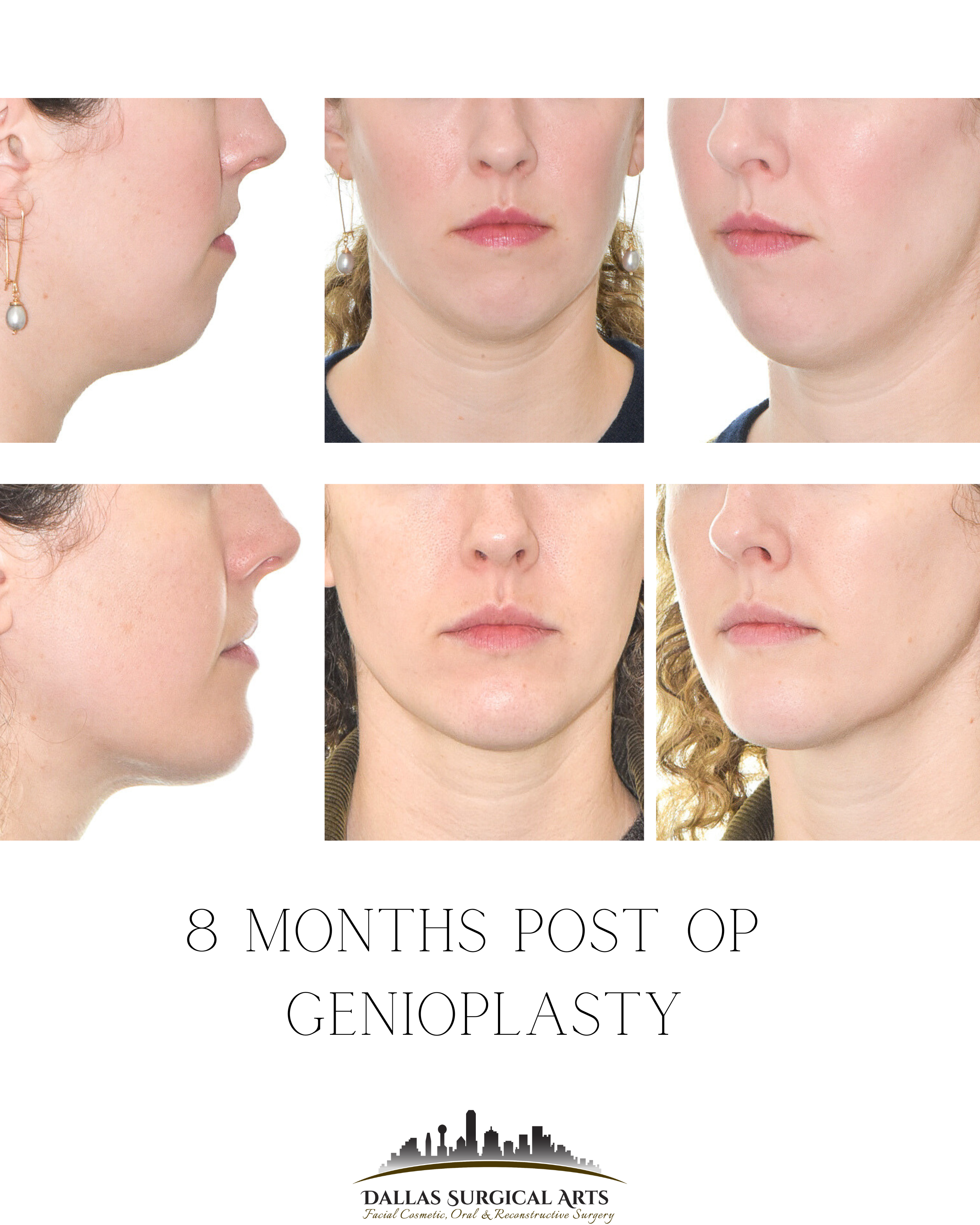Understanding Chin Anatomy and Genioplasty Surgery in Dallas