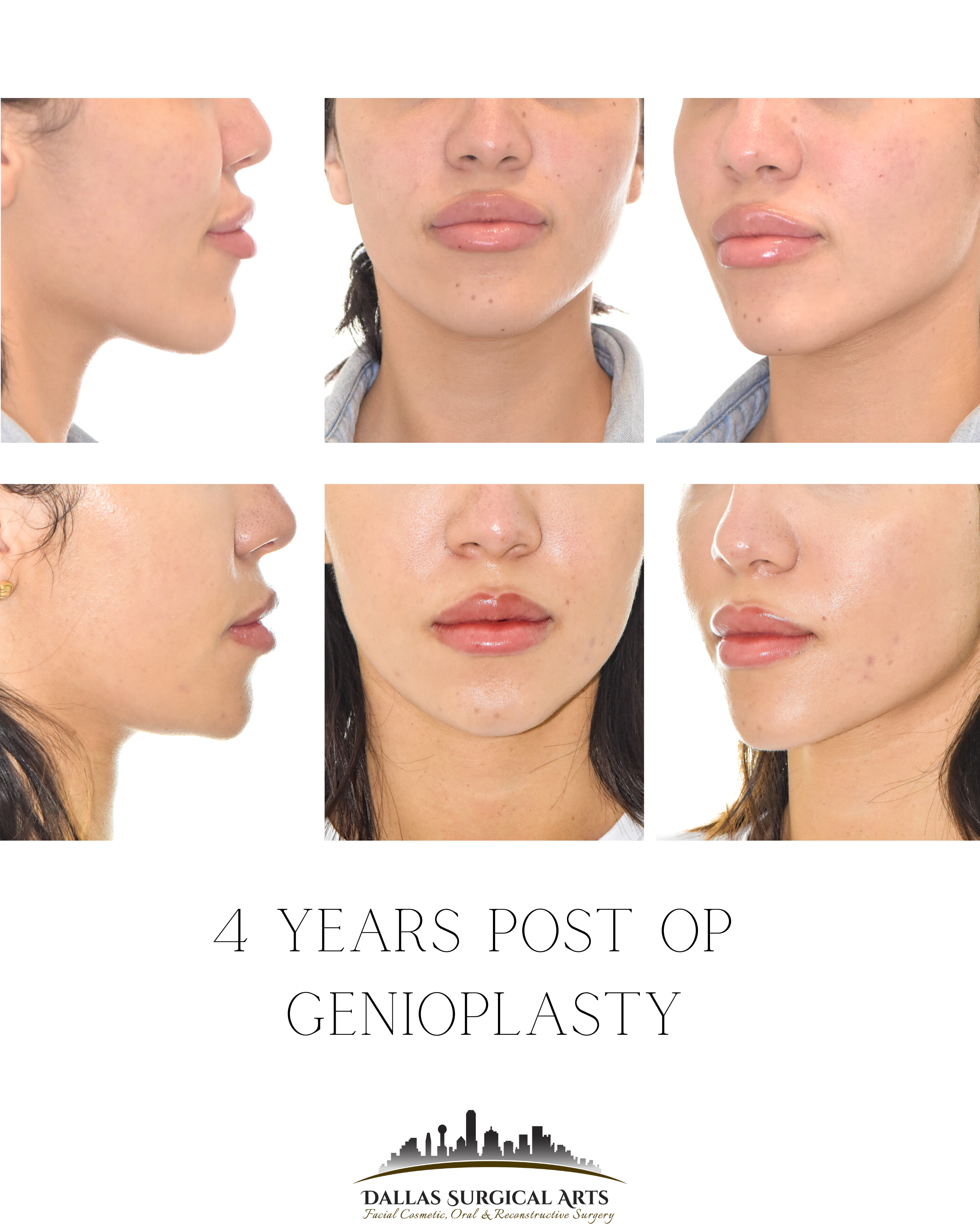 Genioplasty vs. Chin Filler: Which Gives the Best Profile Results?