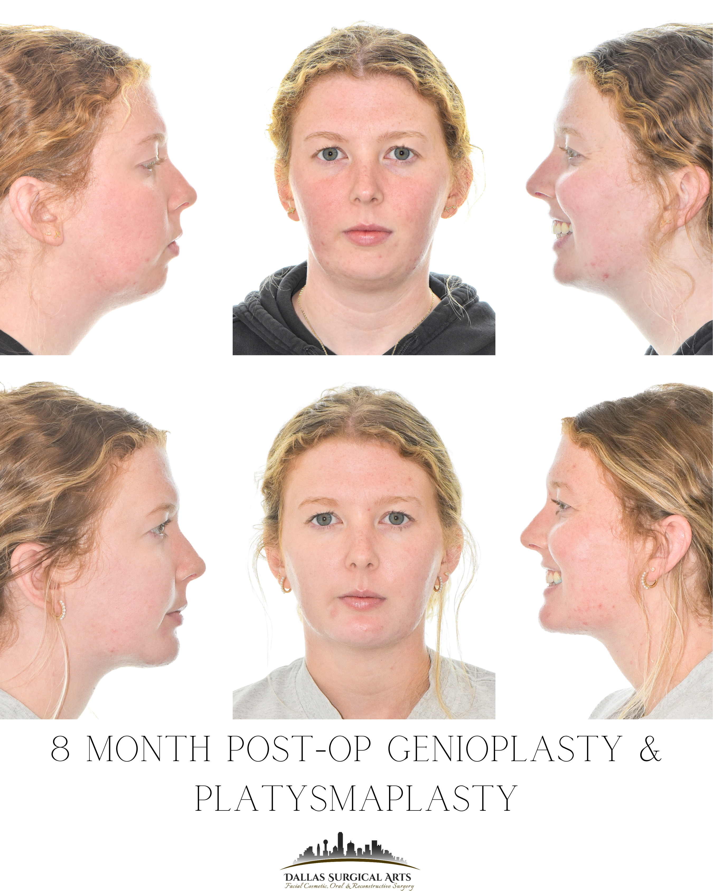 Fixing a Recessed Chin - Genioplasty Surgeon in Dallas