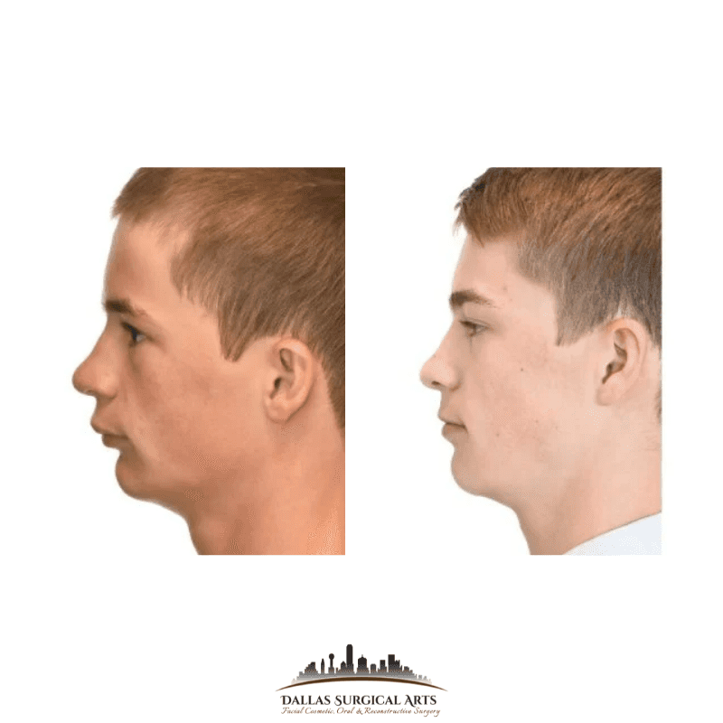 Orthognathic Treatment for Jaw Advancement and Micrognathia by Dr. Randy Sanovich