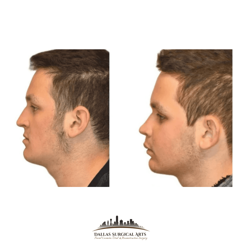 Jaw Repositioning (Orthognathic Surgery) Dallas Surgical Arts
