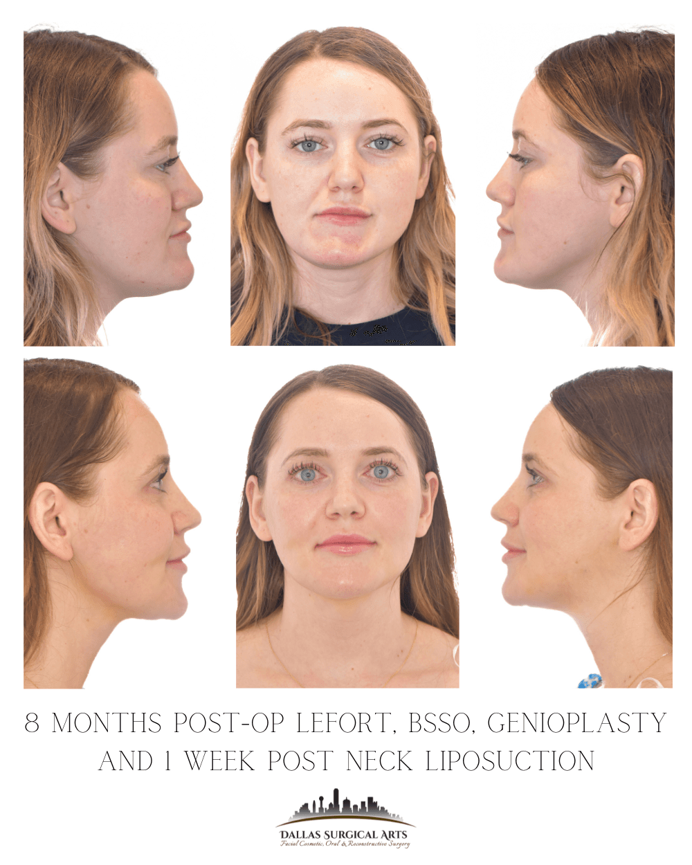 Will Jaw Surgery Change the Way I Look? - Insights from Dr. Randy Sanovich