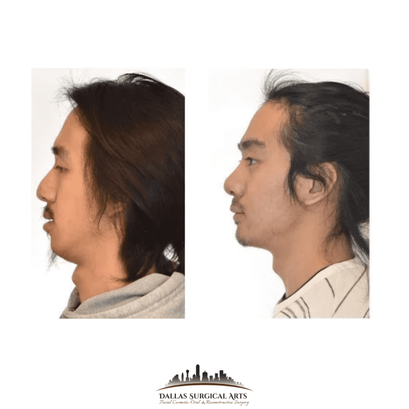 Double Jaw Surgery FAQs