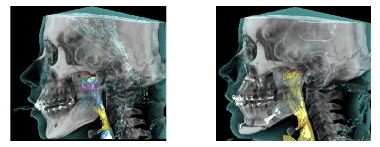 Obstructive Sleep Apnea Treatment at Dallas Surgical Arts