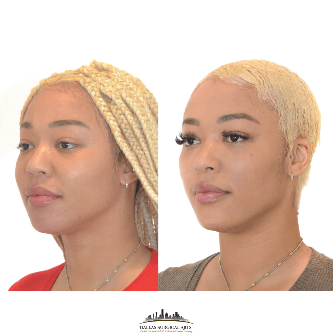 Get Beautifully Enhanced Features with Dallas Face Injections | Dallas Surgical Arts