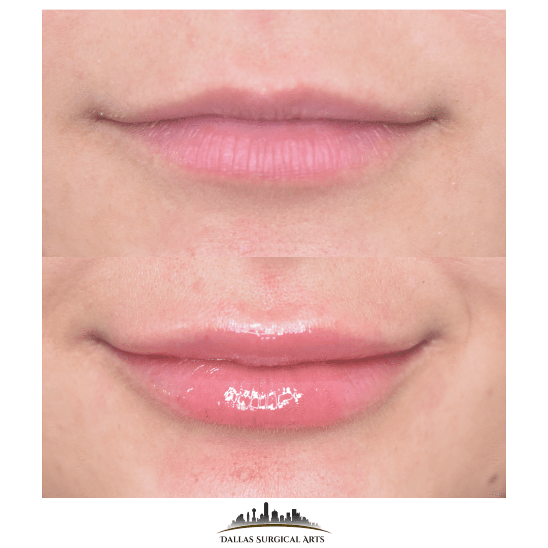 Lip Injections at Dallas Surgical Arts