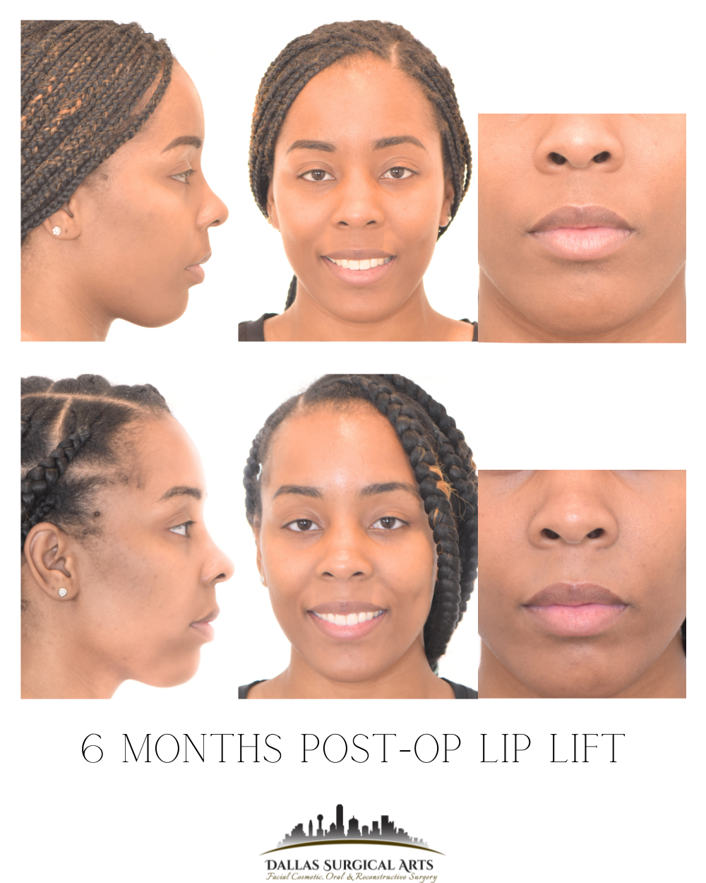 How Much Does Lip Reduction Surgery Cost? Learn About a Lip Lift in Dallas
