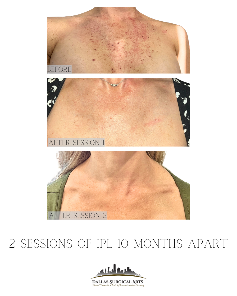 Struggling with Dark Spots? IPL Treatment in Dallas Can Help