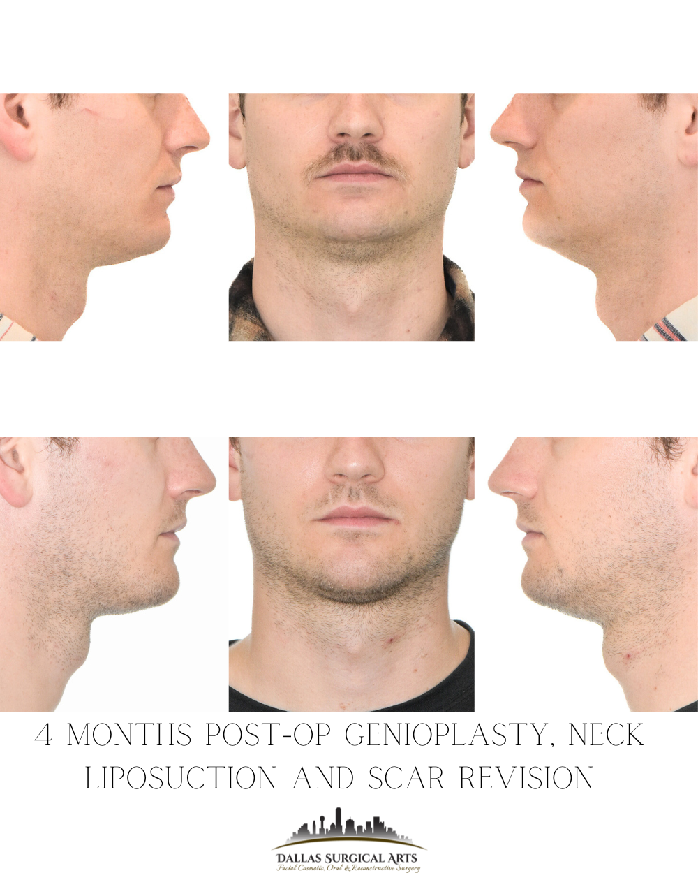 How Much is Chin Lipo in Dallas, Texas?