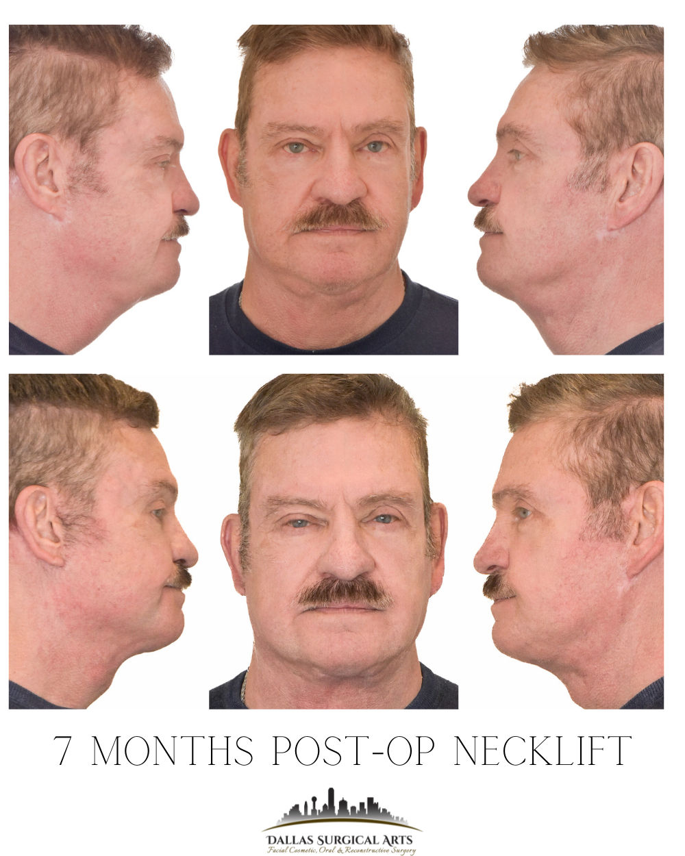 Men’s Neck Lift: Before and After Results from a Board-Certified Surgeon