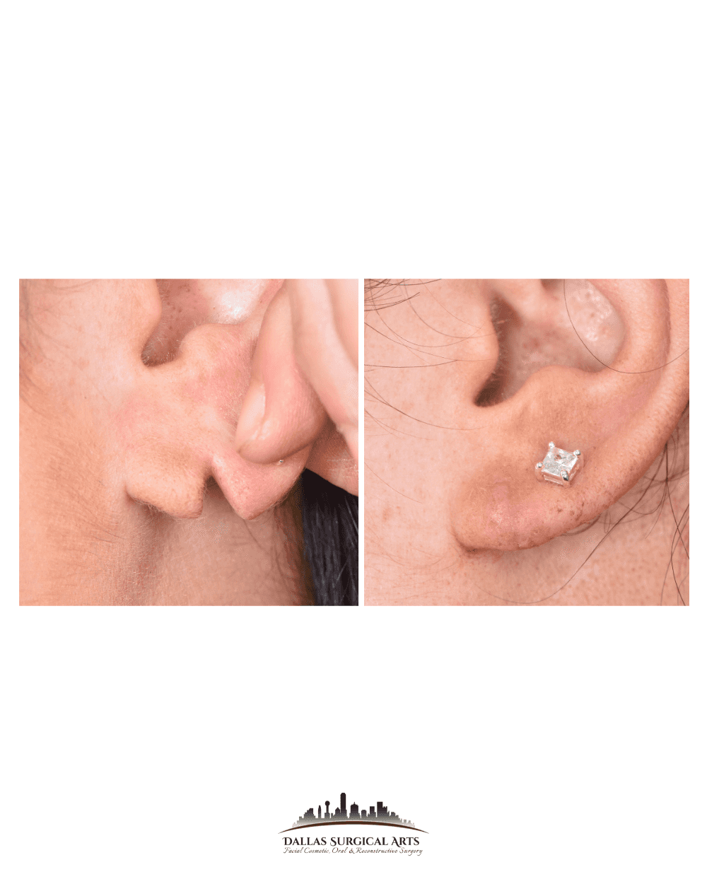 5 Benefits of Earlobe Reduction Surgery You Should Know