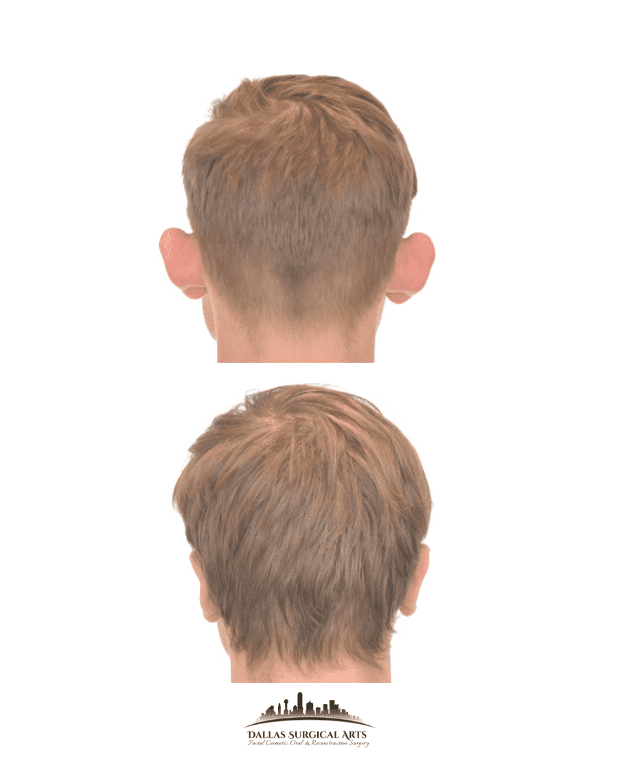 Otoplasty Cost in Dallas: What You Need to Know About Ear Reshaping