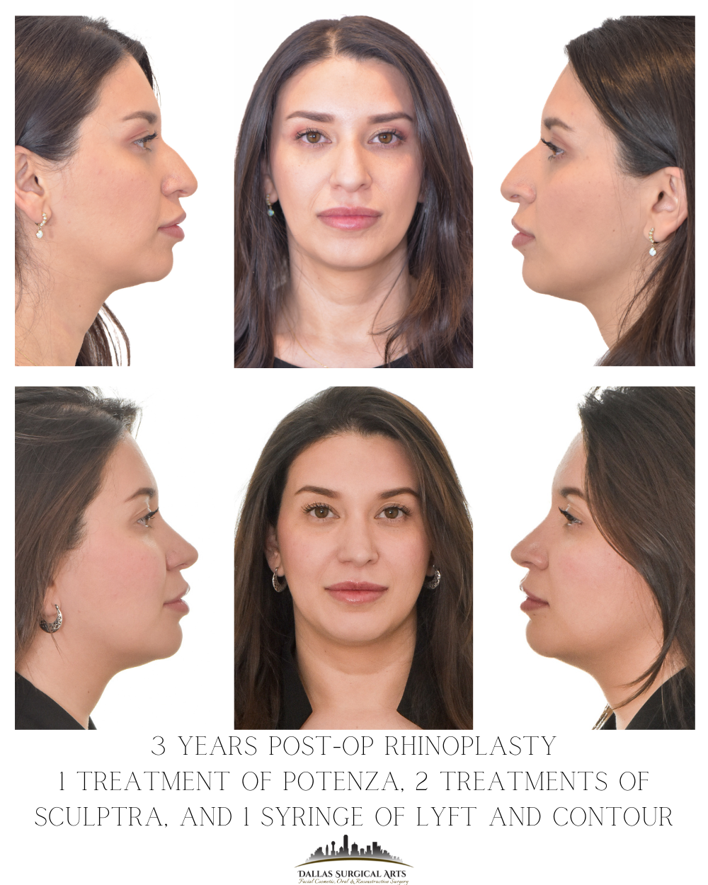 The Truth About Neck Tightening: What Really Works