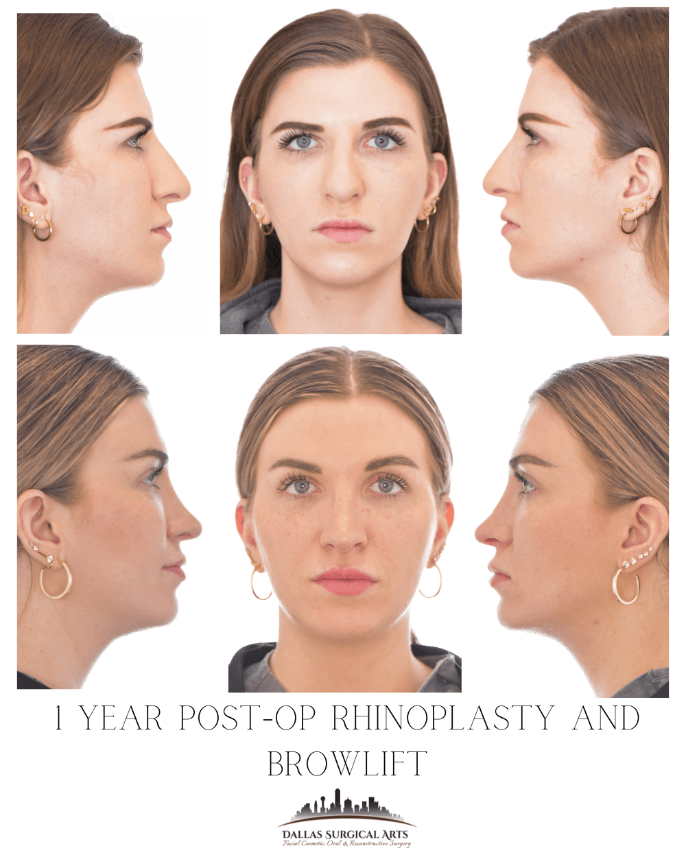 Correcting a Bulbous Nose: Techniques for Refining the Nasal Tip - Insights from Dr. Randy Sanovich