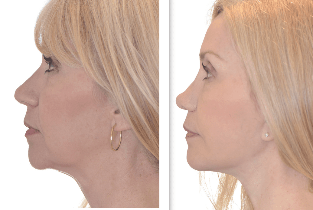 Revision Rhinoplasty in Dallas with Dr. Randy Sanovich
