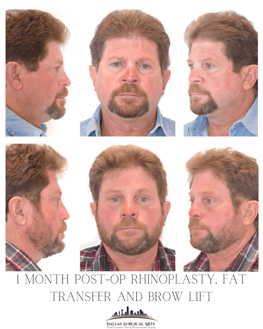 Transform with Rhinoplasty in Dallas