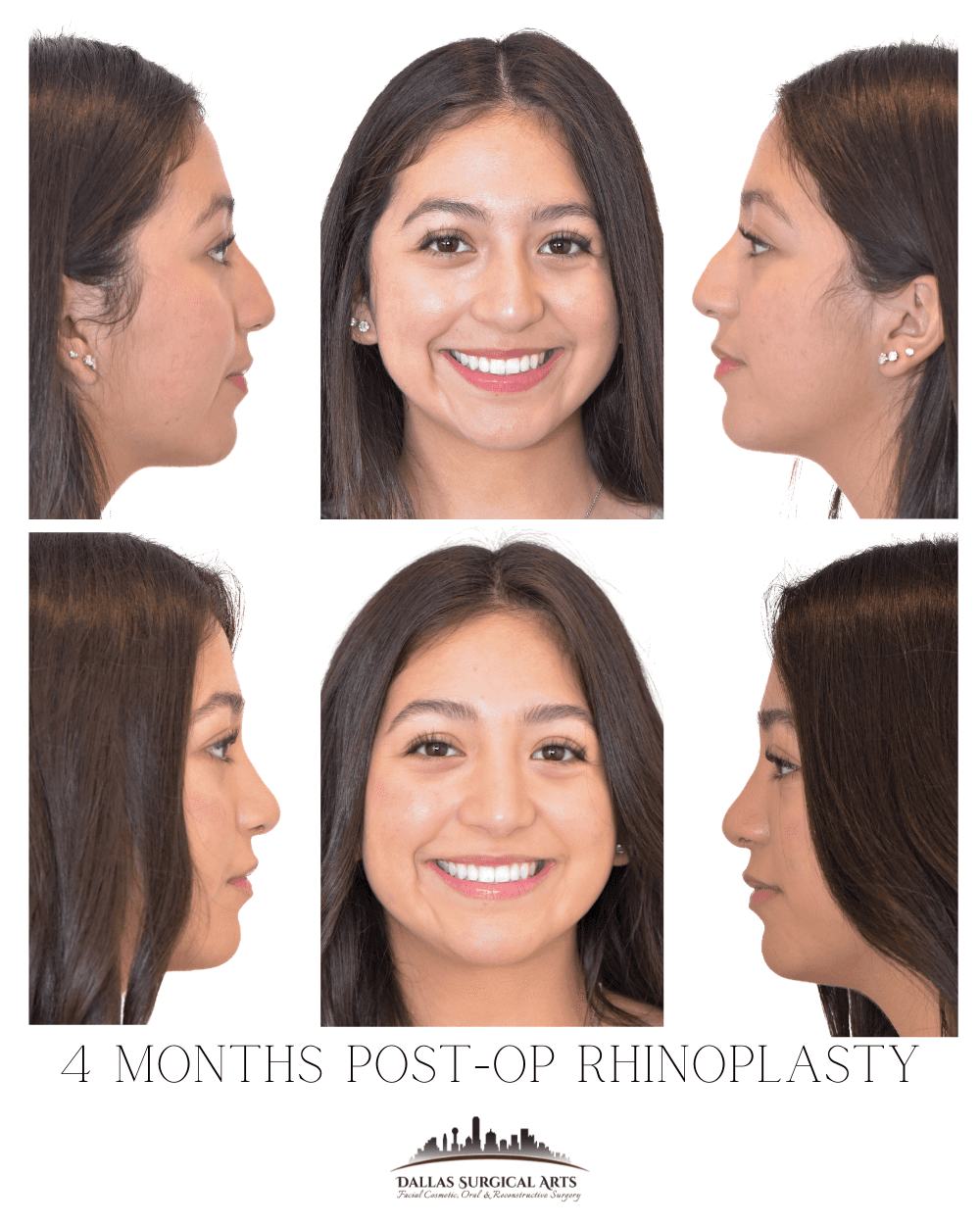Why Gen Z Wants a Nose Job: A Rise in Rhinoplasty Surgery in Dallas